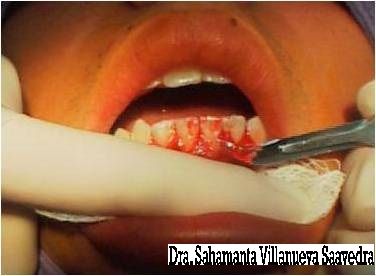 SE PROCEDE A REALIZAR LA GINGIVECTOMIA CON BISTURI