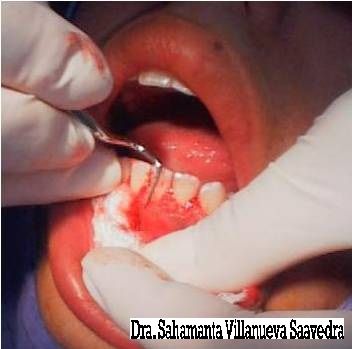 SE PROCEDE A REALIZAR LA GINGIVOPLASTIA, QUE ES REMODELAMIENTO DE LA ENCIA 
