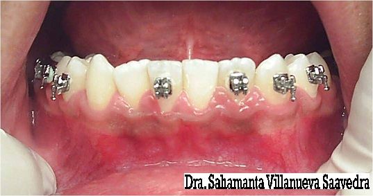 FOTO INICIAL INFERIOR (QUE ES EN DONDE HAY AGRANDAMIENTO GINGIVAL) POR LO QUE SE NECESITARA HACER CIRUGIA