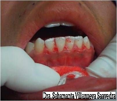 LA GINGIVECTOMIA TERMINADA